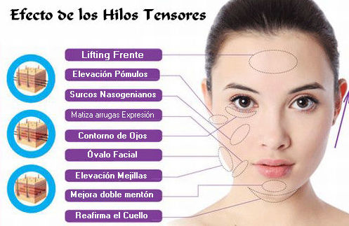 HILOS TENSORES: Tratamientos de Centro de belleza y medicina estética Lucy Lara HILOS TENSORES: Tratamientos de Centro de belleza y medicina estética Lucy Lara