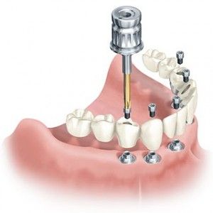 Implantes Implantes