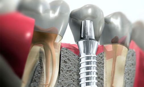 Implantología: Tratamientos de Centro Dental Europa Implantología: Tratamientos de Centro Dental Europa