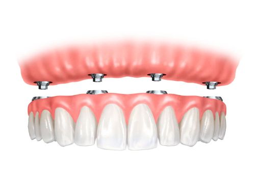 Odontología restauradora: Tratamientos de Centro Dental Europa Odontología restauradora: Tratamientos de Centro Dental Europa