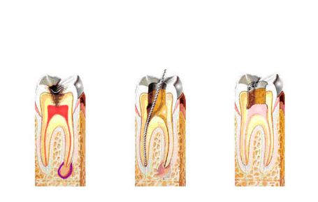 Endodoncia: Tratamientos de Centro Dental Europa Endodoncia: Tratamientos de Centro Dental Europa