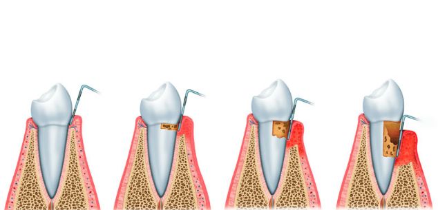 Periodoncia: Tratamientos de Centro Dental Europa Periodoncia: Tratamientos de Centro Dental Europa