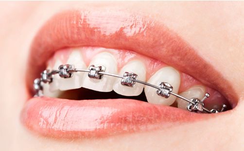 Ortodoncia: Tratamientos de Centro Dental Europa Ortodoncia: Tratamientos de Centro Dental Europa