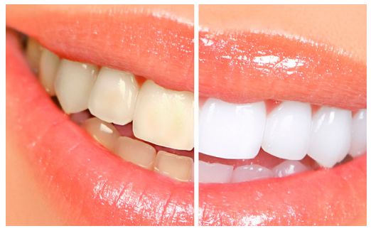 Estética dental: Tratamientos de Centro Dental Europa Estética dental: Tratamientos de Centro Dental Europa