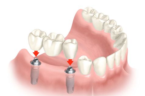 Rehabilitación protésica: Tratamientos de Centro Dental Europa Rehabilitación protésica: Tratamientos de Centro Dental Europa