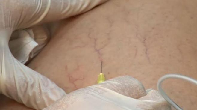 ESCLEROSIS VASCULAR ESCLEROSIS VASCULAR