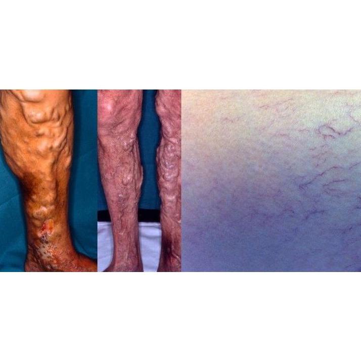 Arañas vasculares. Varices y sus complicaciones. : Productos y servicios de Consulta Barreiro-Vascular (Dr. A. Barreiro Mouro) Arañas vasculares. Varices y sus complicaciones. : Productos y servicios de Consulta Barreiro-Vascular (Dr. A. Barreiro Mouro)
