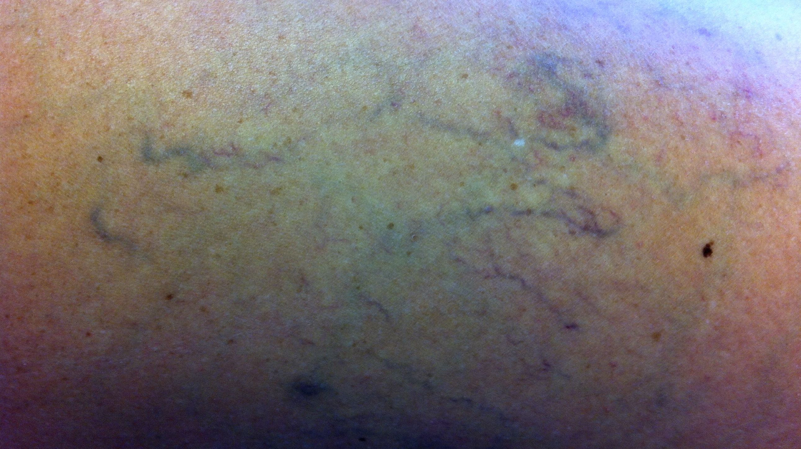 Telangiectasias y varículas Telangiectasias y varículas
