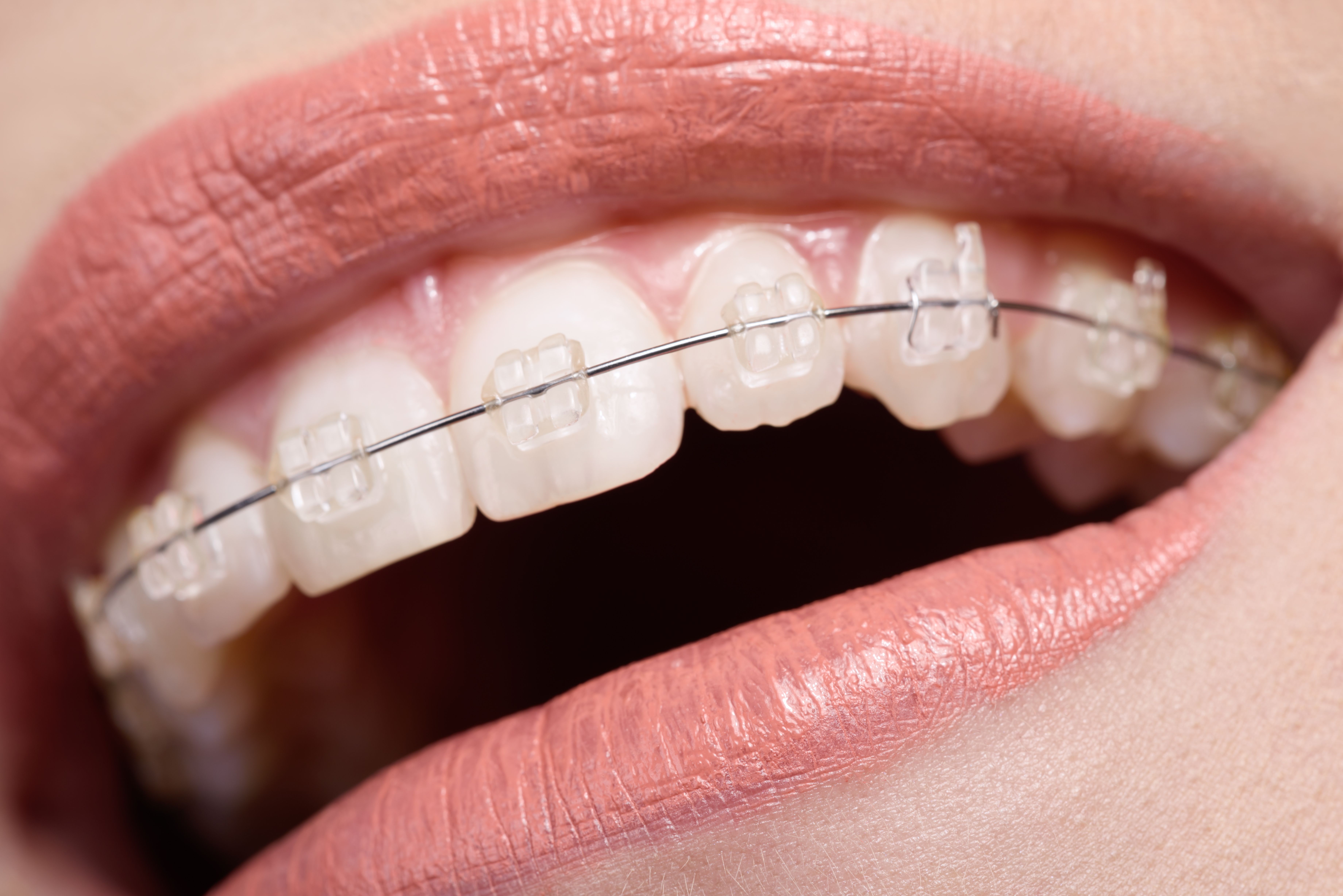 Ortodoncia: Tratamientos de CLÍNICA DENTAL GIRONÉS CALDÉS