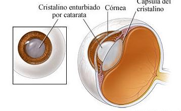 Tratamiento de la Catarata: Servicios de Dr. Alfonso Piñero