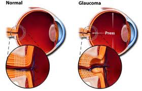 cirugía del glaucoma