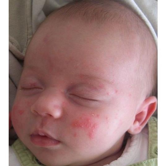 Dermatología Pediátrica : Especialidades de Reyes Ramírez, A. Dermatología Pediátrica : Especialidades de Reyes Ramírez, A.