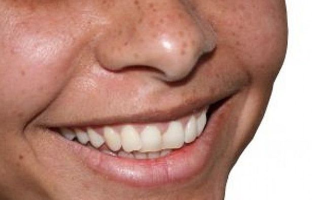 Prótesis dental: Tratamientos de Vitaldent Prótesis dental: Tratamientos de Vitaldent