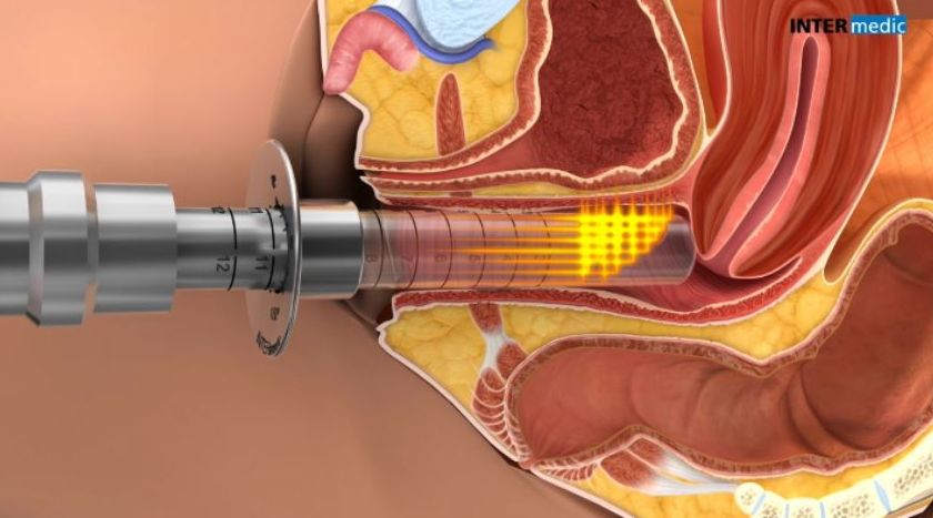 Laser Vaginal in Almeria