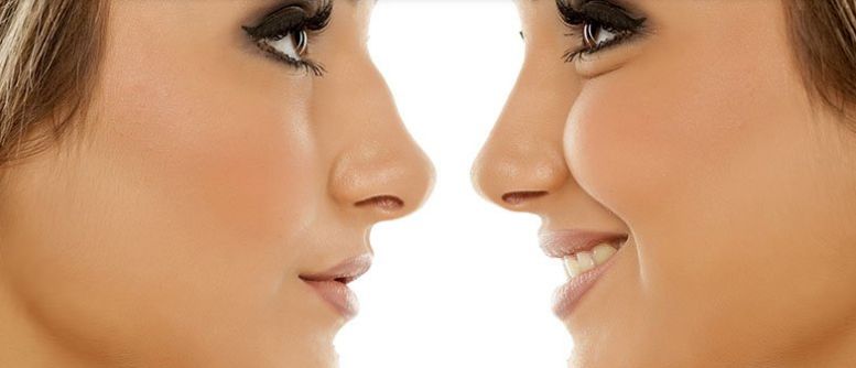 Rinomodelación no quirúrgica: Tratamientos de Aurea Esthetic Rinomodelación no quirúrgica: Tratamientos de Aurea Esthetic