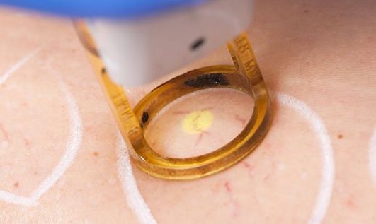 Esclerosis de varices: Tratamientos de Aurea Esthetic Esclerosis de varices: Tratamientos de Aurea Esthetic