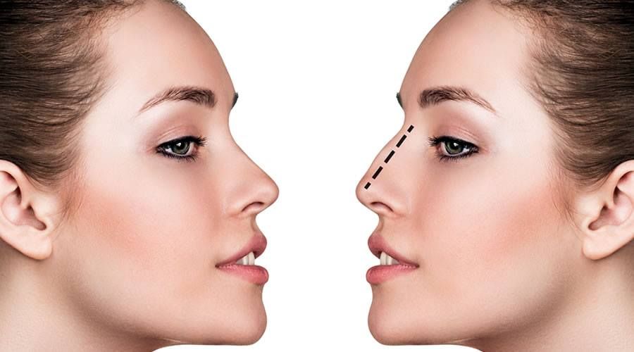 Rinomodelación no quirúrgica: Tratamientos de Aurea Esthetic Rinomodelación no quirúrgica: Tratamientos de Aurea Esthetic