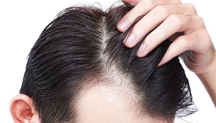 Mesoterapia capilar: Tratamientos de Aurea Esthetic Mesoterapia capilar: Tratamientos de Aurea Esthetic