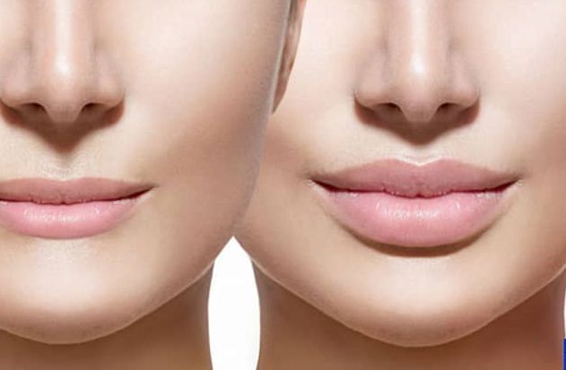 Remodelación labial: Tratamientos de Aurea Esthetic Remodelación labial: Tratamientos de Aurea Esthetic