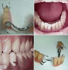 Foto 12 de Protésicos dentales en Madrid | Ángel Dueñas Laboratorio Dental