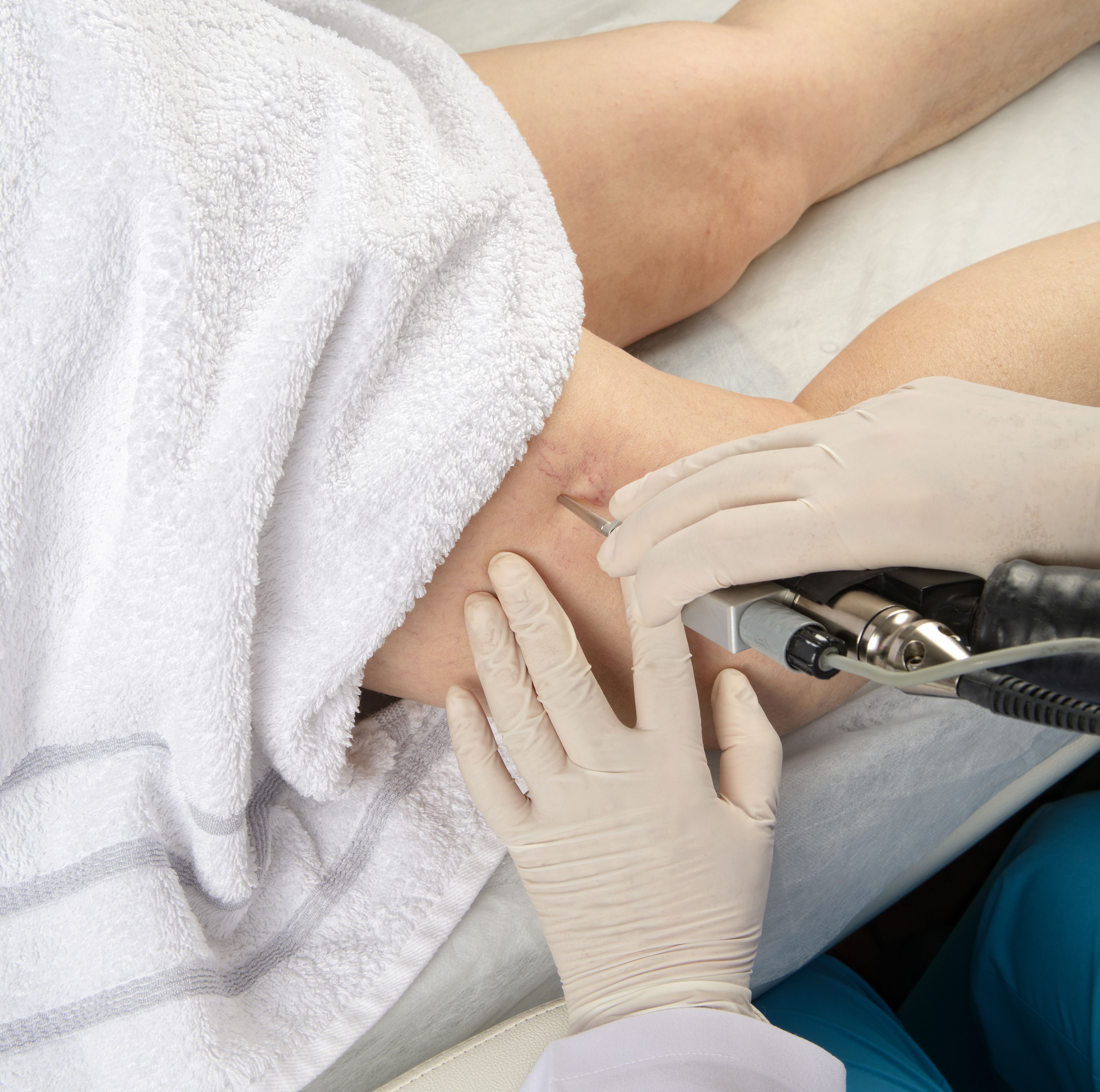 Escleroterapia: Nuestros tratamientos de Clínica Doctor Pérez de León Escleroterapia: Nuestros tratamientos de Clínica Doctor Pérez de León