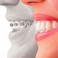 Ortodoncia: Servicios de Clínica Dental Irudent }}