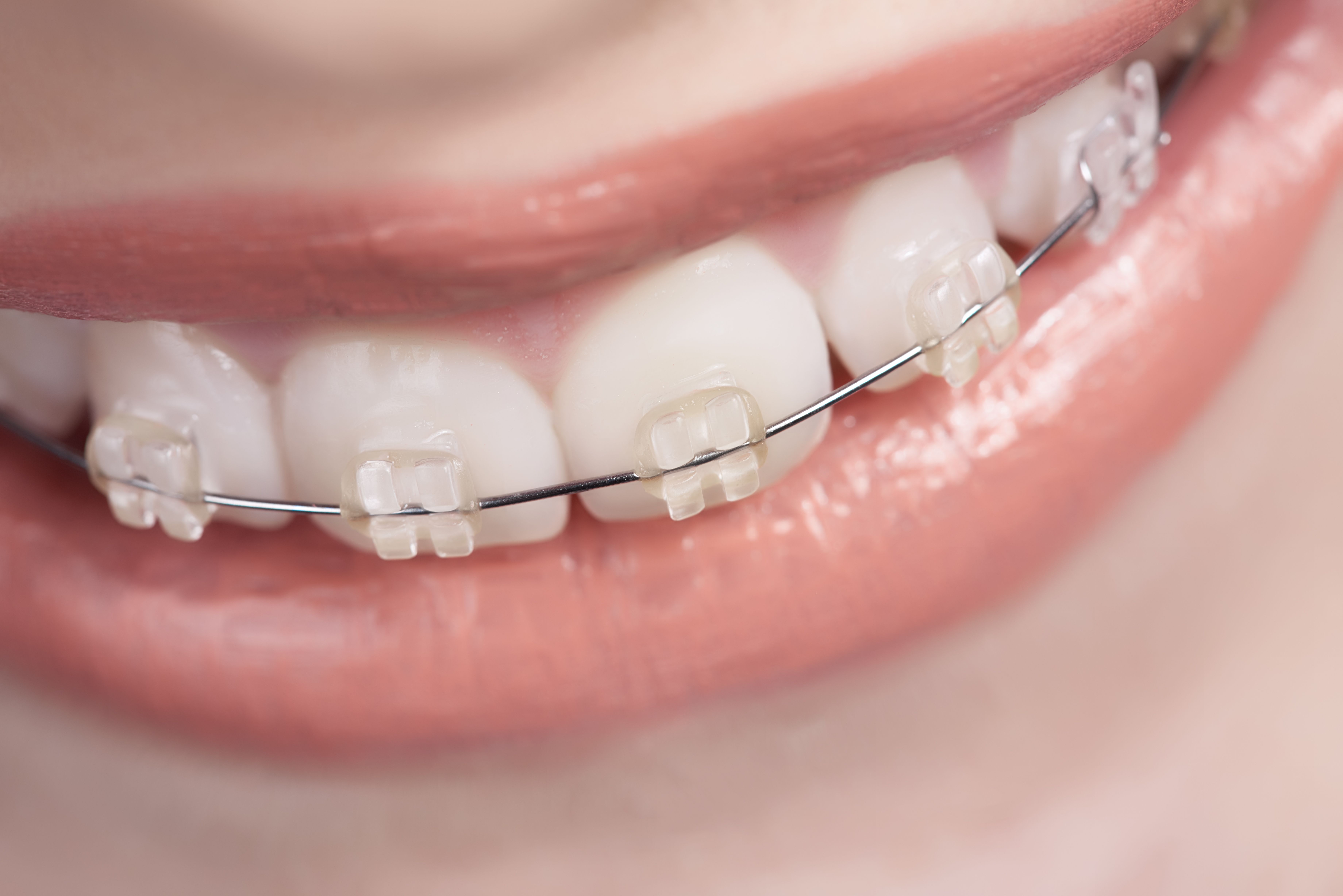 Ortodoncia con brackets convencionales: Servicios de Clinica Dental Garó Ortodoncia con brackets convencionales: Servicios de Clinica Dental Garó