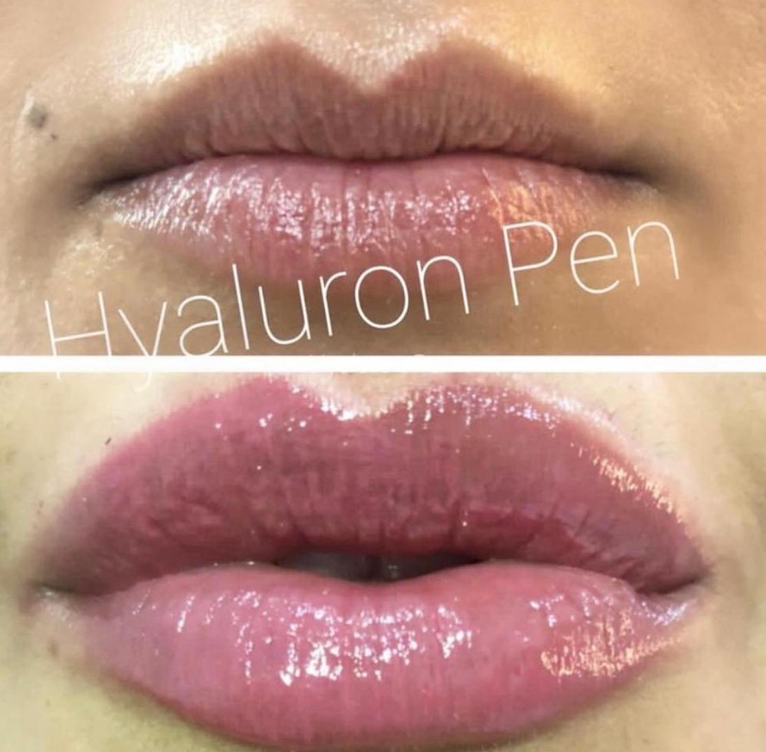 Hyaluroni Pen: Servicios de 13 Rosas Tattoo Hyaluroni Pen: Servicios de 13 Rosas Tattoo