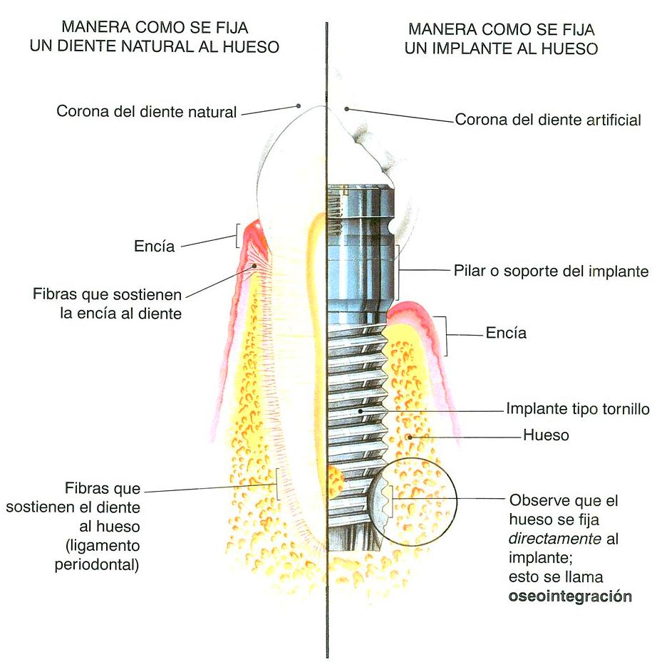 Implantes: Tratamientos de Maite Pérez Corrales Implantes: Tratamientos de Maite Pérez Corrales
