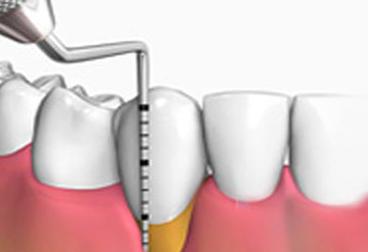 Periodoncia: Tratamientos de Maite Pérez Corrales Periodoncia: Tratamientos de Maite Pérez Corrales
