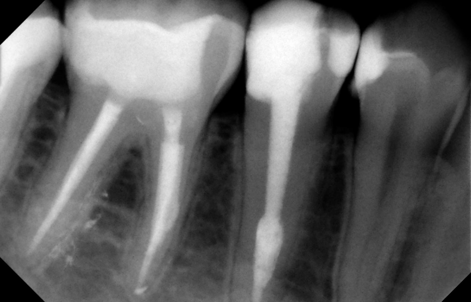 Endodoncias: Tratamientos de Maite Pérez Corrales Endodoncias: Tratamientos de Maite Pérez Corrales