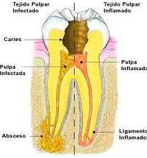 Endodoncias: Tratamientos de Maite Pérez Corrales Endodoncias: Tratamientos de Maite Pérez Corrales