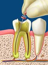Endodoncias: Tratamientos de Maite Pérez Corrales Endodoncias: Tratamientos de Maite Pérez Corrales