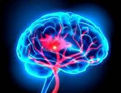 Accidentes cerebrovasculares Accidentes cerebrovasculares