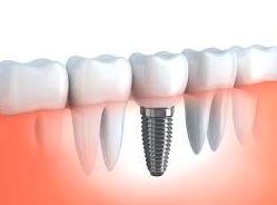 Implante Dental Implante Dental