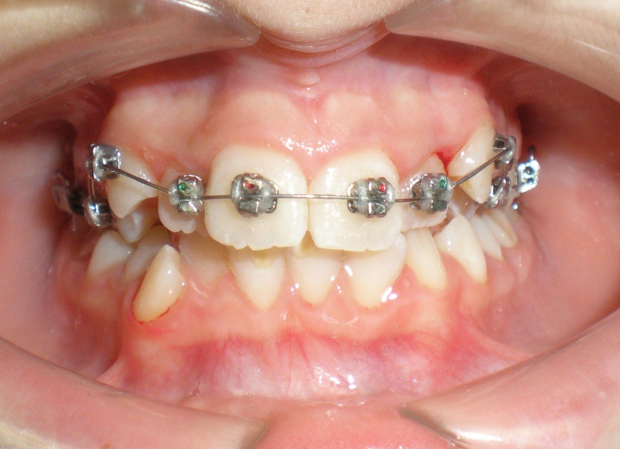 BRACKETS BRACKETS