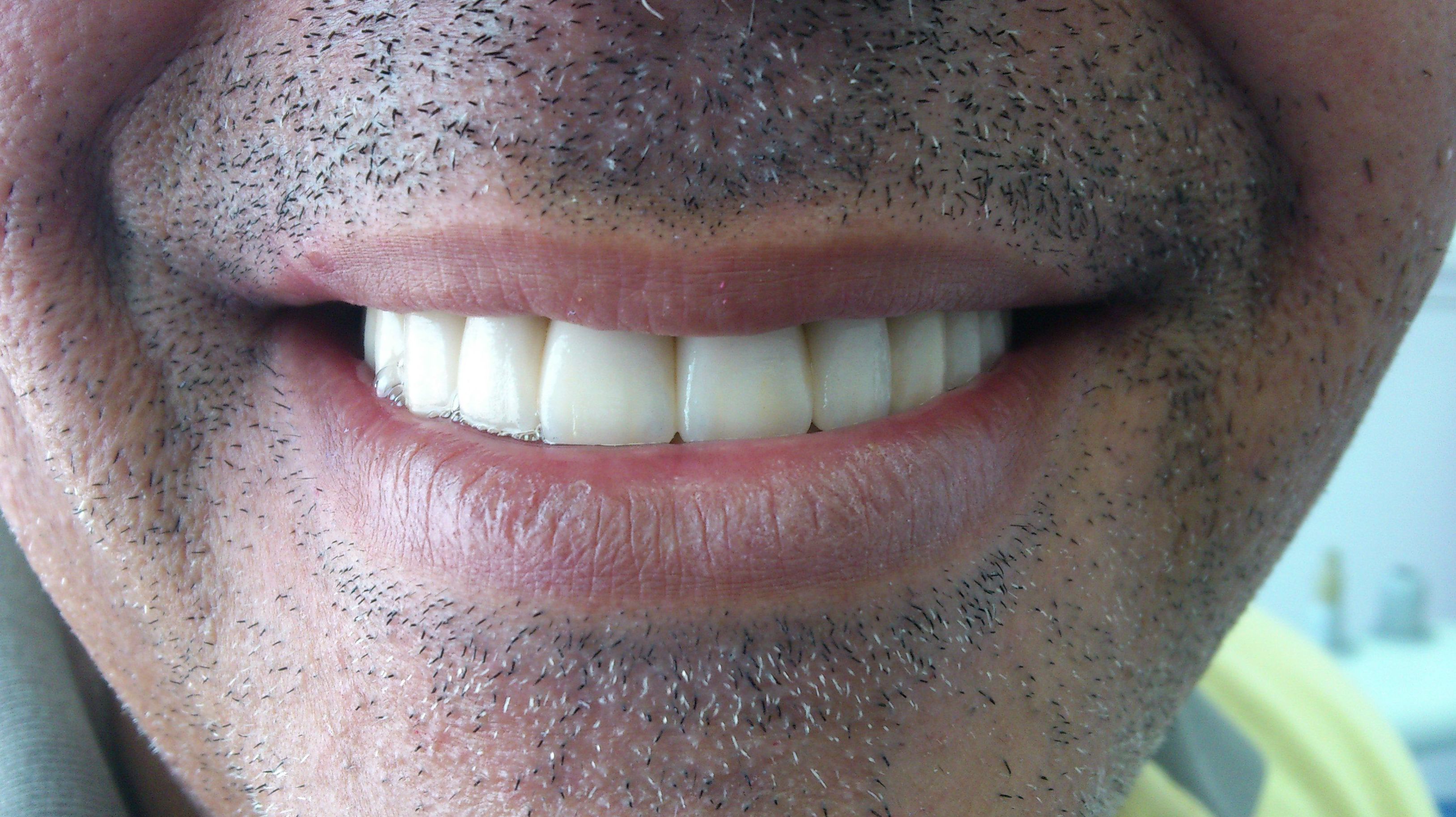 Implantes: Nuestros servicios de Clínica Dental Balbarán Implantes: Nuestros servicios de Clínica Dental Balbarán
