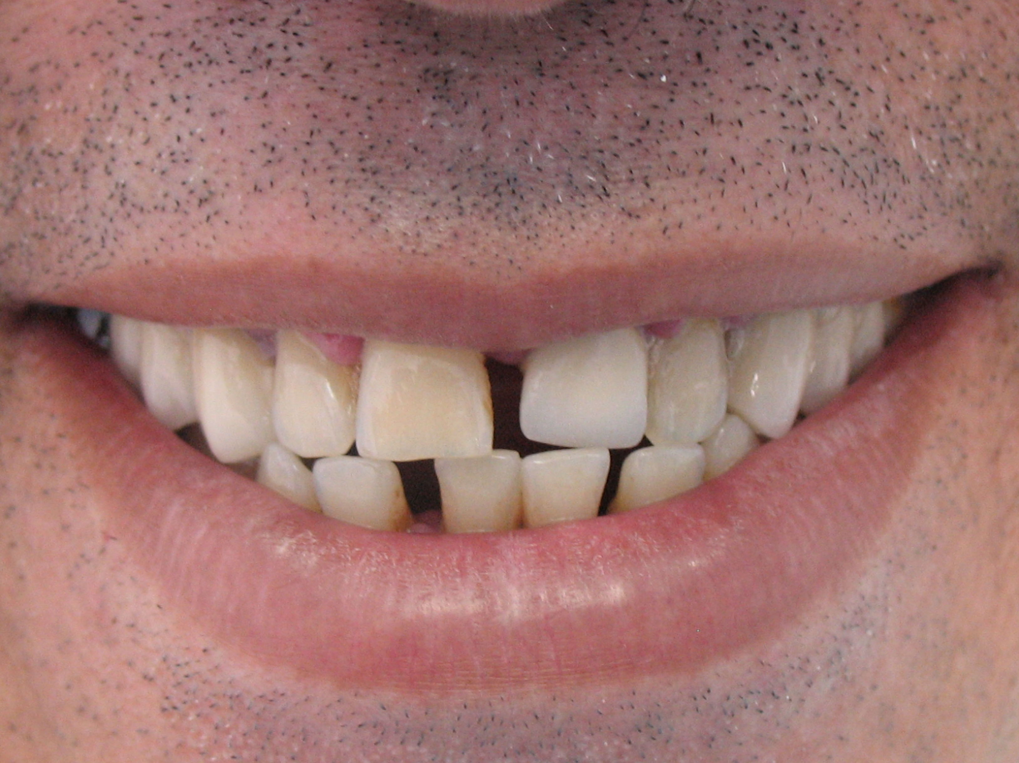 Implantes: Nuestros servicios de Clínica Dental Balbarán Implantes: Nuestros servicios de Clínica Dental Balbarán