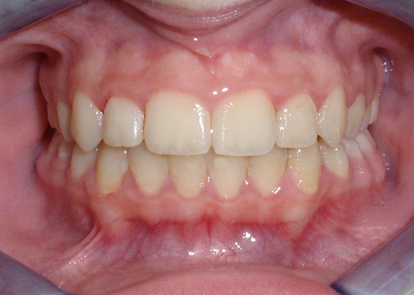 BRACKETS BRACKETS