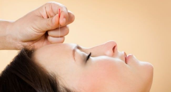 Lifting facial con acupuntura: Servicios de Terapies Naturals BIB Lifting facial con acupuntura: Servicios de Terapies Naturals BIB