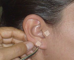 Auriculoterapia: Servicios de Terapies Naturals BIB Auriculoterapia: Servicios de Terapies Naturals BIB