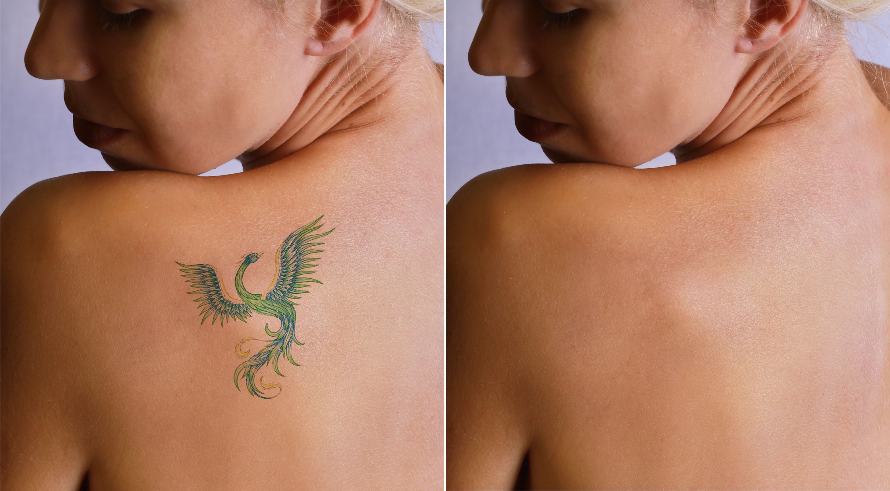 Eliminación de tatuajes: Tratamientos de Fabián Mirón Medicina Estética Eliminación de tatuajes: Tratamientos de Fabián Mirón Medicina Estética