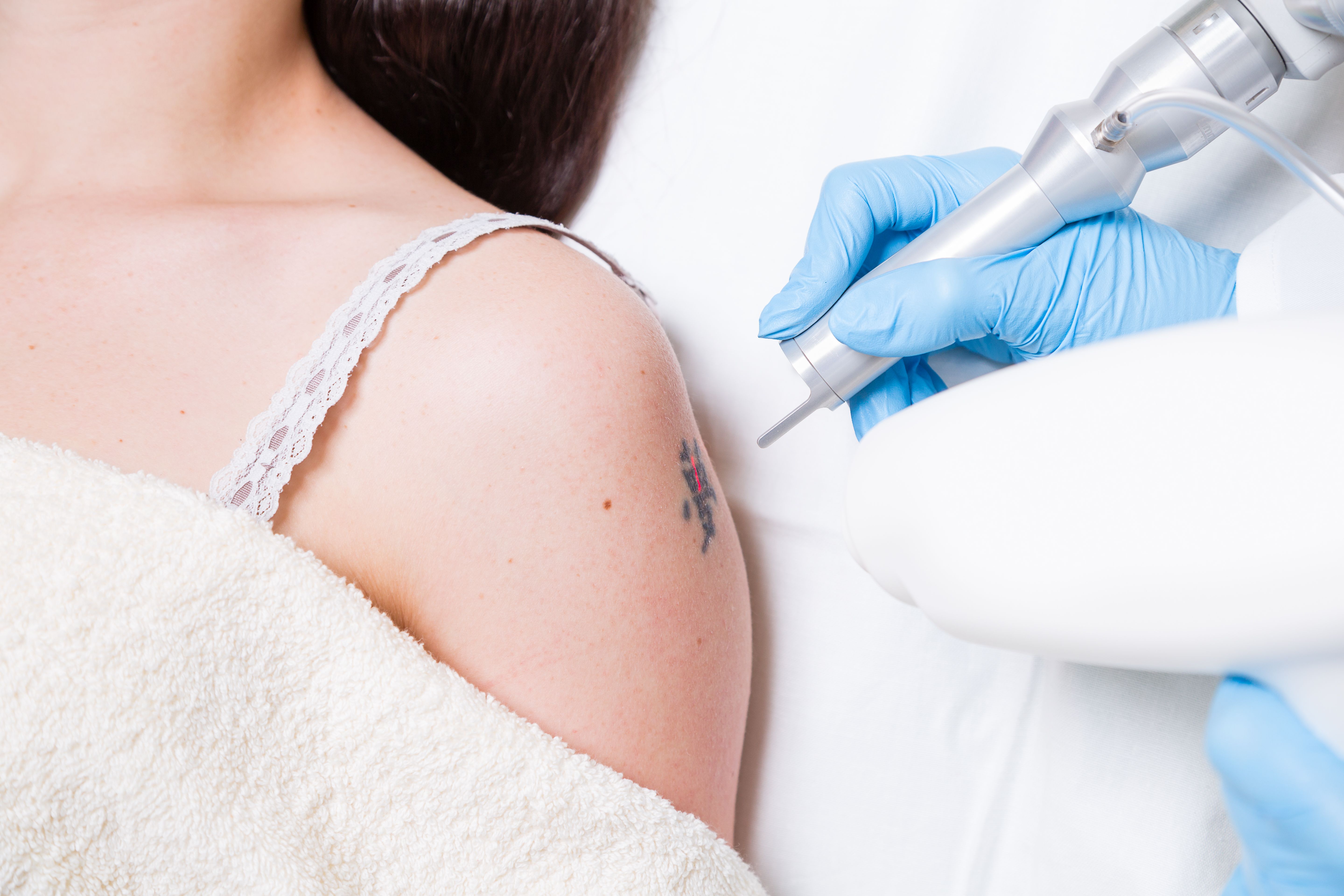 Eliminación de tatuajes: Tratamientos de Fabián Mirón Medicina Estética Eliminación de tatuajes: Tratamientos de Fabián Mirón Medicina Estética