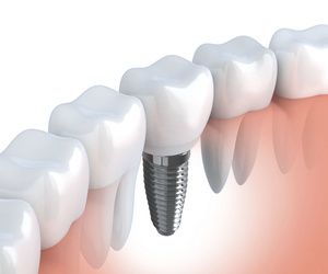 Implantes: Nuestros servicios de Clínica Dental Garraf Implantes: Nuestros servicios de Clínica Dental Garraf