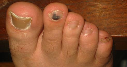 Uñas : Servicio al paciente de Clínica del Pie Rut Delgado Uñas : Servicio al paciente de Clínica del Pie Rut Delgado
