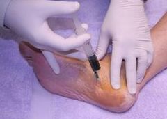 INFILTRACIONES: TRATAMIENTOS-ESPECIALIDADES de Alper Podólogos Clínica Podológica INFILTRACIONES: TRATAMIENTOS-ESPECIALIDADES de Alper Podólogos Clínica Podológica